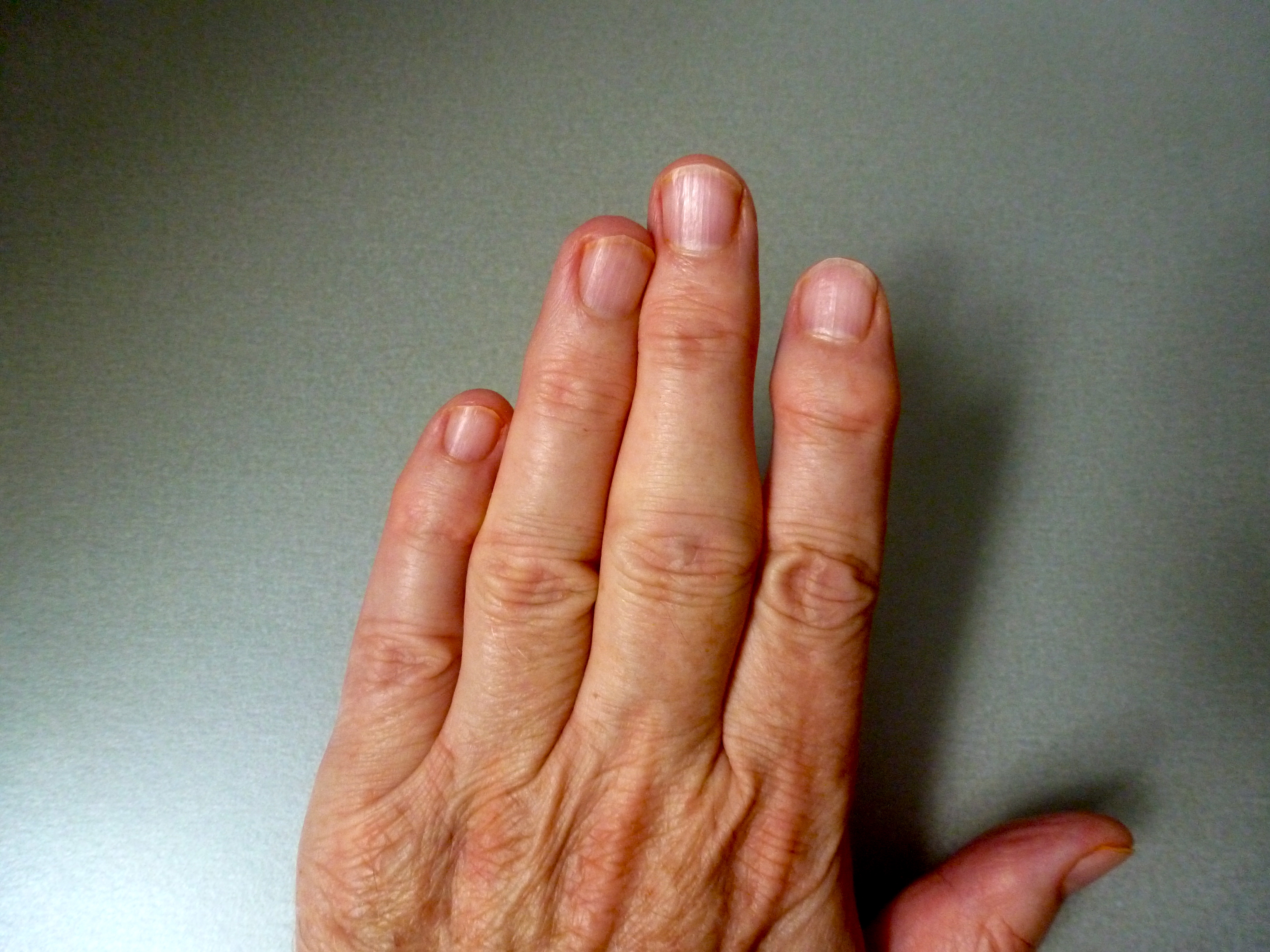 Ревматоидный артрит суставов кистей